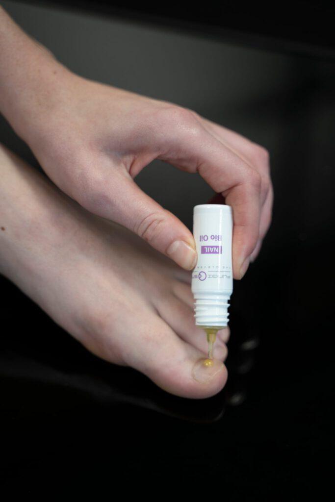 Wat Te Doen Bij Schimmelnagels?